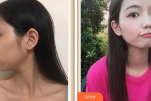 上海氧顏醫(yī)療美容門診部王建麗整形價(jià)格表附水氧案例展示