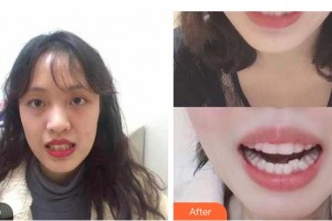 上海匯尚口腔門診部高悅整形價(jià)格表附全隱形牙齒矯正案例展示