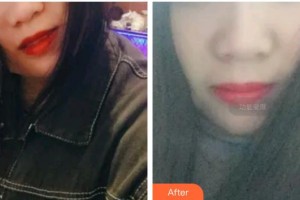 上海雅悅口腔門診部閆阿強(qiáng)整形價(jià)格表附超聲波潔牙案例展示