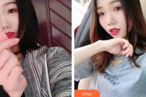 上海迪寇醫(yī)療美容門診部任亮整形價(jià)格表附多方面部埋線提升案例展示