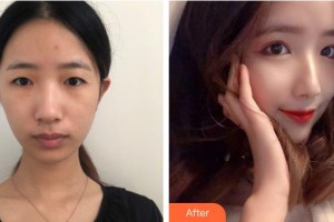 上海?，斎鹨曆劭漆t(yī)院李俊整形價(jià)格表附眼部整形案例展示