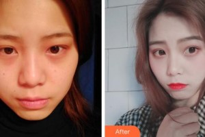 上海福仁眼科門診部王江橋整形價(jià)格表附全切雙眼皮案例展示
