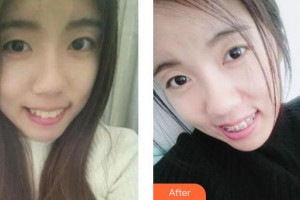 上海永華口腔門診部仇玲整形價(jià)格表附牙齒隱形矯正案例展示