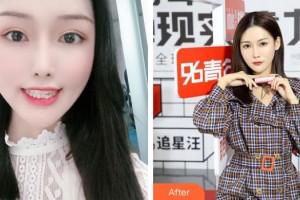 上海雅圣口腔門(mén)診部劉玉春整形價(jià)格表附隱形矯正案例展示