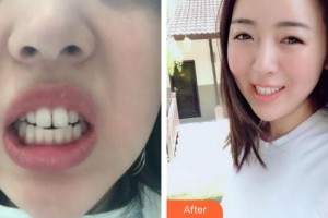上海維樂(lè)口腔門(mén)診部沈華整形價(jià)格表附門(mén)牙擁擠、齙牙案例展示