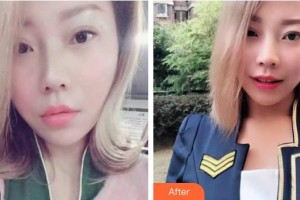 上海摩爾口腔門(mén)診部陳建榮整形價(jià)格表附牙齒隱形矯正案例展示