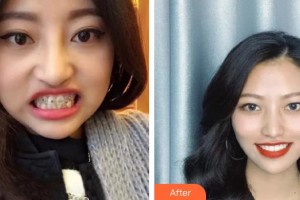 上海匯尚口腔門(mén)診部王刃整形價(jià)格表附牙齒矯正案例展示