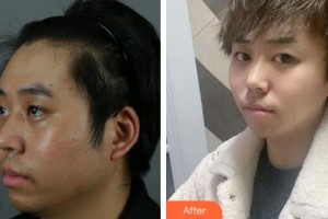 上海紐菲思醫(yī)療美容門(mén)診部曾垂紳整形價(jià)格表附下頜角整形案例展示