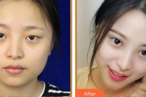 上海容妍醫(yī)療美容門(mén)診部柴云整形價(jià)格表附鼻部手術(shù)案例展示