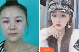 上海容妍醫(yī)療美容門(mén)診部袁鹿整形價(jià)格表附面包臉到鴨蛋臉變形記案例展示