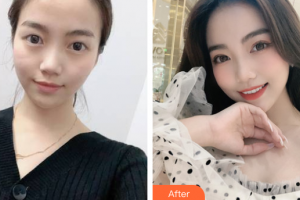 上海德媛醫(yī)療美容門(mén)診部閔香花整形價(jià)格表附埋線雙眼皮案例展示