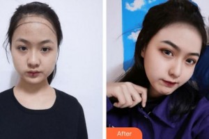 上海萊森醫(yī)療美容門(mén)診部李少雄整形價(jià)格表附美女發(fā)際線種植案例展示