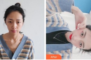 上海星璨醫(yī)療美容醫(yī)院劉宇整形價(jià)格表附發(fā)際線案例展示