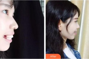 上海伊萊美醫(yī)療美容醫(yī)院陳秀梅整形價(jià)格表附齙牙小仙女案例展示