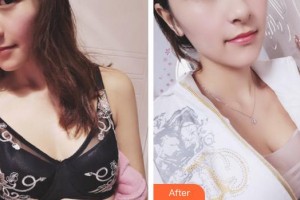 上海明珠醫(yī)院整形美容中心張東旭整形價(jià)格表附濃縮豐胸真實(shí)案例展示