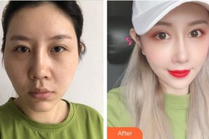 上海知音醫(yī)院醫(yī)療美容科曾憲文整形價(jià)格表附顴骨顴弓整形術(shù)顴骨顴弓整形案例展示