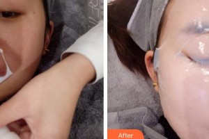 上海歐萊美醫(yī)療美容醫(yī)院南承喜整形價(jià)格表附光子嫩膚案例展示