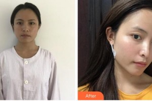 上海臻妮醫(yī)療美容門診部湯玉祥，男，主治醫(yī)生，畢業(yè)整形價格表附創(chuàng)可貼面部吸脂瘦臉案例展示