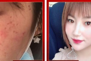 上海天美醫(yī)療美容醫(yī)院沐依依整形價格表附微針美膚案例展示