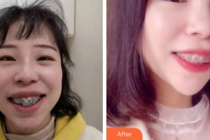 上海雅悅口腔門診部薛云華整形價(jià)格表附金屬托槽矯正牙齒案例展示