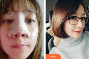 上海醫(yī)顏醫(yī)療美容門診部李曙光整形價(jià)格表附鼻部手術(shù)案例展示