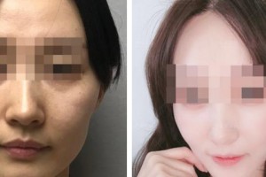 上海醫(yī)顏醫(yī)療美容門診部余韋臻整形價(jià)格表附熱瑪吉案例展示