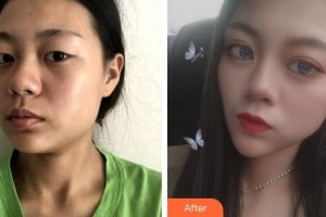 上海維樂(lè)口腔門診部柯良騏整形價(jià)格表附下頜角整形案例展示