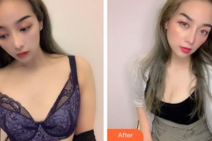 成都米蘭柏羽醫(yī)學(xué)美容醫(yī)院蔣中川整形價(jià)格表附濃縮豐胸真實(shí)案例展示