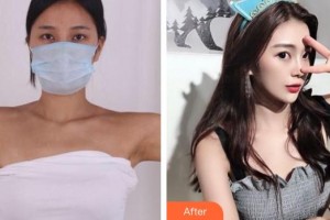 成都市第三人民醫(yī)院醫(yī)學(xué)整形美容科梁靜萍整形價格表附手臂吸脂案例展示