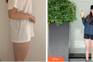 成都市第三人民醫(yī)院醫(yī)學(xué)整形美容科葉飛輪整形價格表附大腿吸脂案例展示