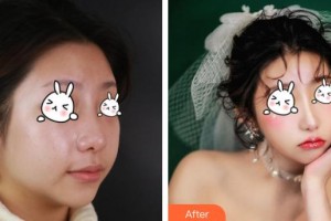 成都市第三人民醫(yī)院醫(yī)學(xué)整形美容科段冬梅整形價格表附紅寶石激光祛斑案例展示