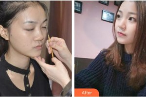 成都米蘭柏羽醫(yī)學(xué)美容醫(yī)院唐林俊整形價格表附假體隆鼻+鼻頭塑形案例展示