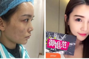 成都米蘭柏羽醫(yī)學(xué)美容醫(yī)院王煬整形價格表附激光美膚祛斑案例展示