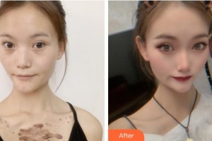 成都美容整形醫(yī)院瞿維鈞整形價格表附疤痕疙瘩案例展示