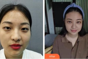 成都西區(qū)醫(yī)院醫(yī)學(xué)美容科瑪麗整形價格表附眉毛不上揚案例展示