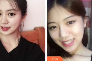 廣州星團醫(yī)學(xué)美容門診部邱煥標整形價格表附面部輪廓案例展示