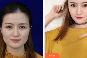 廣州曙光醫(yī)學美容醫(yī)院王娟整形價格表附面部吸脂案例展示