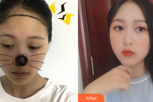 廣州荔醫(yī)醫(yī)療美容門診部何凱強整形價格表附發(fā)際線案例展示