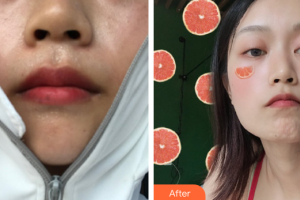 廣州華美醫(yī)療美容醫(yī)院朱葛勇整形價格表附光子嫩膚案例展示