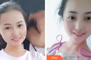 廣州華美醫(yī)療美容醫(yī)院肖海云整形價格表附冷光美白案例展示