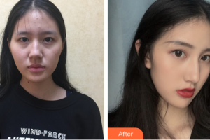 廣州博研醫(yī)療美容門診部陳伯華整形價格表附隆鼻案例展示