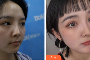 廣州美恩整形美容醫(yī)院鄒麗莉整形價格表附眼部綜合案例展示