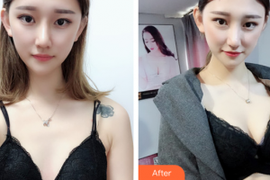 廣州市紅十字會醫(yī)院燒傷整形科謝有富整形價格表附自體脂肪隆胸案例展示