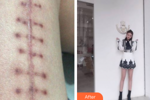 廣州市紅十字會醫(yī)院燒傷整形科李葉揚(yáng)整形價格表附微創(chuàng)疤痕修復(fù)案例展示