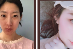 南京素麗醫(yī)療美容診所邢麗君整形價(jià)格表附肋軟骨隆鼻案例展示