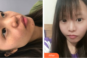 廣州市紅十字會醫(yī)院燒傷整形科梁達(dá)榮整形價格表附面部疤痕去除案例展示