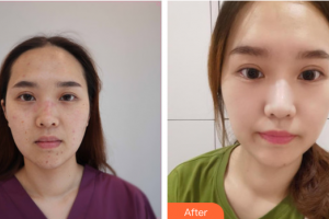 廣州中家醫(yī)家庭醫(yī)生醫(yī)學(xué)整形美容醫(yī)院申汶錫整形價格表附激光祛痣點痣案例展示