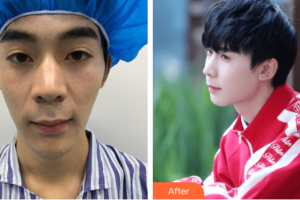 廣州博仕整形美容醫(yī)院朱曉春整形價格表附鼻部手術(shù)案例展示