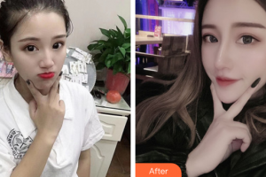 廣州南珠醫(yī)療美容門診部王晉煌整形價格表附鼻部手術(shù)案例展示