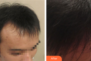 廣州新發(fā)現(xiàn)植發(fā)連鎖機(jī)構(gòu)吳安利整形價格表附種植發(fā)際線案例展示